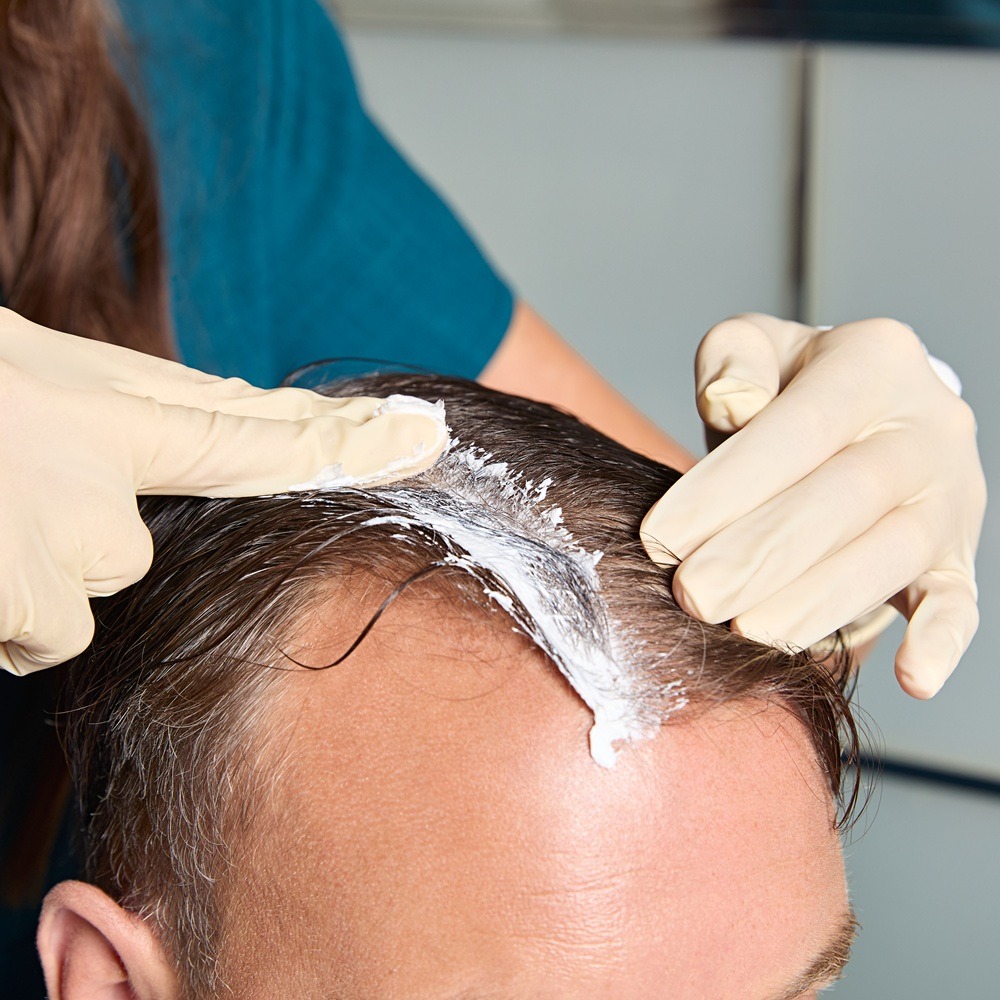 Scalp disorders