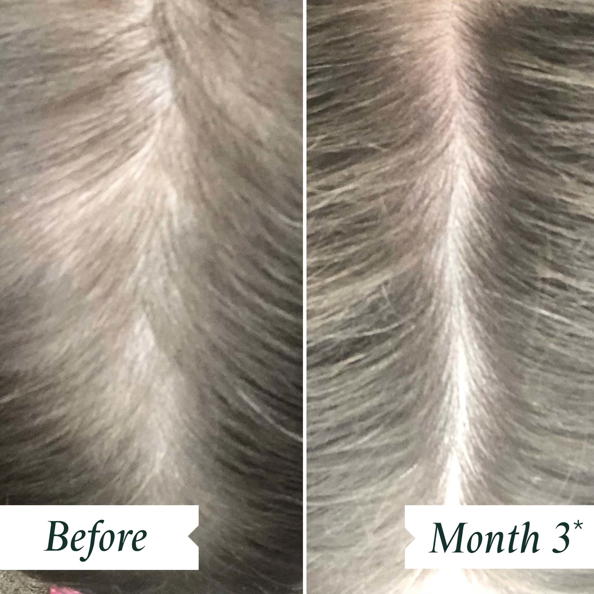 INDEPENDENT USER TRIAL – BEFORE AND AFTER 3 MONTHS OF CONTINUED DAILY USAGE OF DENSITY PRESERVING SCALP DROPS.