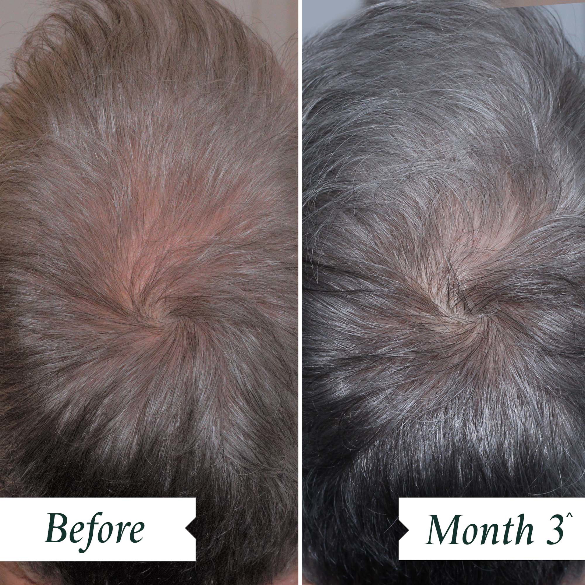 INDEPENDENT CLINICAL TRIAL – BEFORE AND AFTER 3 MONTHS OF CONTINUED DAILY USAGE OF DENSITY PRESERVING SCALP DROPS.